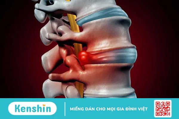 Lồi đĩa đệm là gì ? cách điều trị bênh.