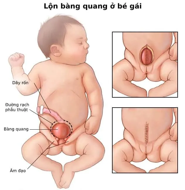 Lộn bàng quang