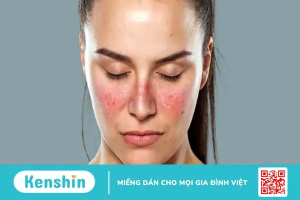 Lupus ban đỏ