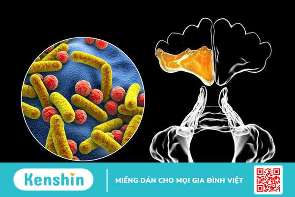 Mách bạn cách chữa viêm xoang có mủ an toàn, hiệu quả nhanh