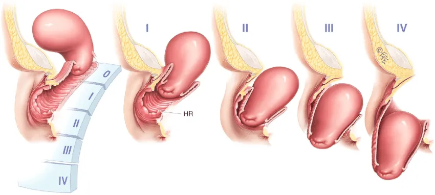 Mách mẹ sau sinh 6 bài tập chữa sa tử cung (sa sinh dục) tại nhà