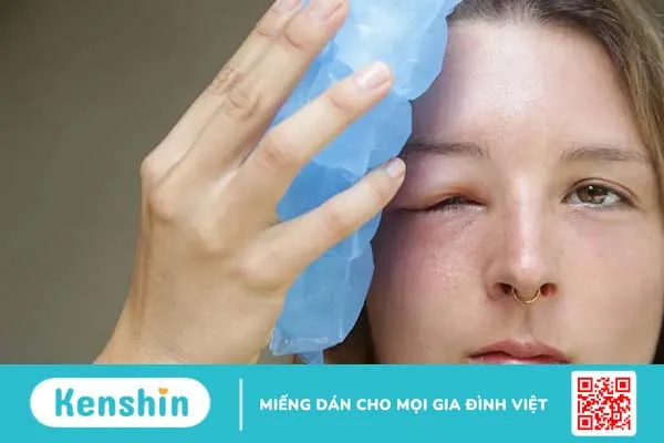 Mắt bị sưng mí trên: Nguyên nhân do đâu và cách điều trị?