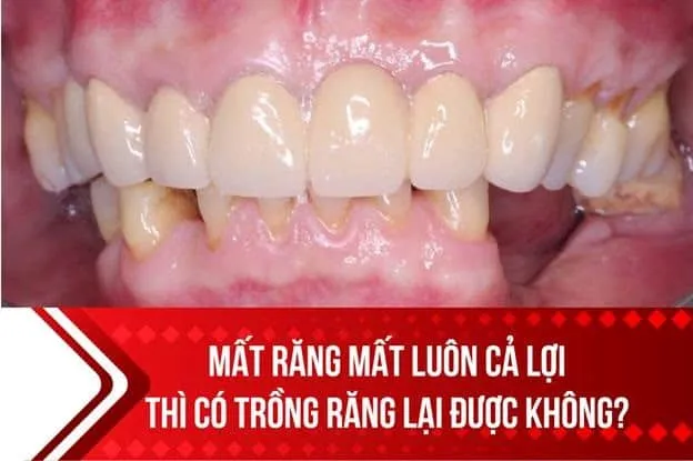 Mất răng lâu năm có trồng lại được không?