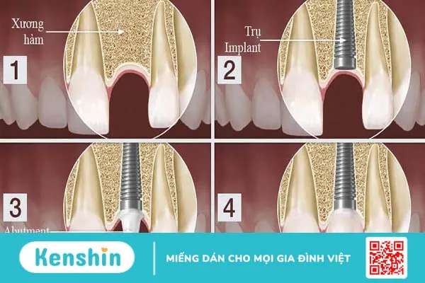 Mất răng lâu năm có trồng lại được không?