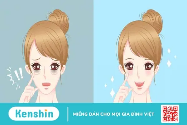 Mắt thâm là bệnh gì? Tiềm ẩn nhiều rủi ro không lường trước!