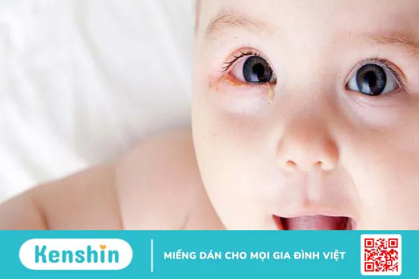 Mắt trẻ sơ sinh đổ ghèn do đâu? Vệ sinh mắt cho bé như thế nào là đúng?