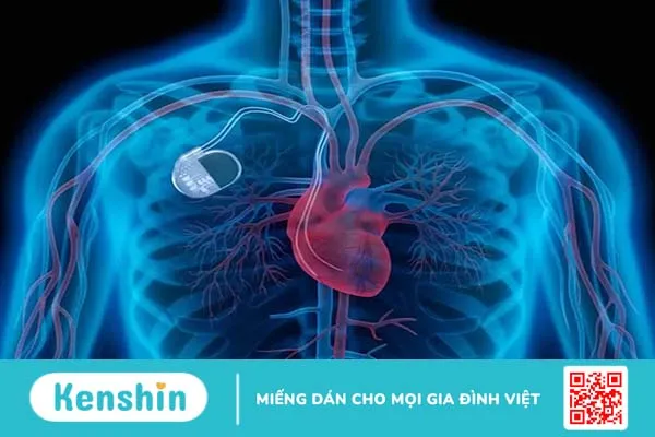 Máy tạo nhịp tim cho người già hoạt động ra sao? Lưu ý gì khi sử dụng?