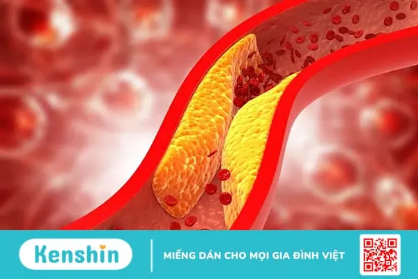 Mỡ máu Tâm Bình có tốt không? Lưu ý dành cho người tăng lipid máu