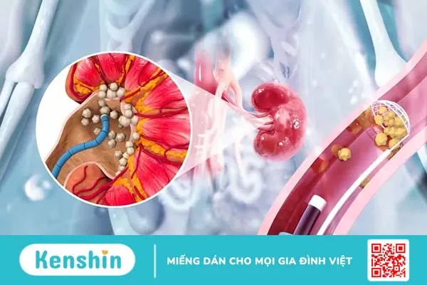 Mổ nội soi sỏi thận là gì? Khi nào được chỉ định?