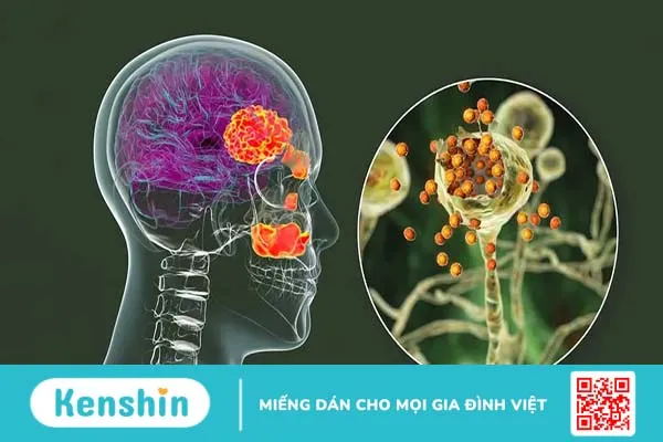 Mổ viêm xoang: Những điều cần lưu ý trước và sau khi phẫu thuật xoang