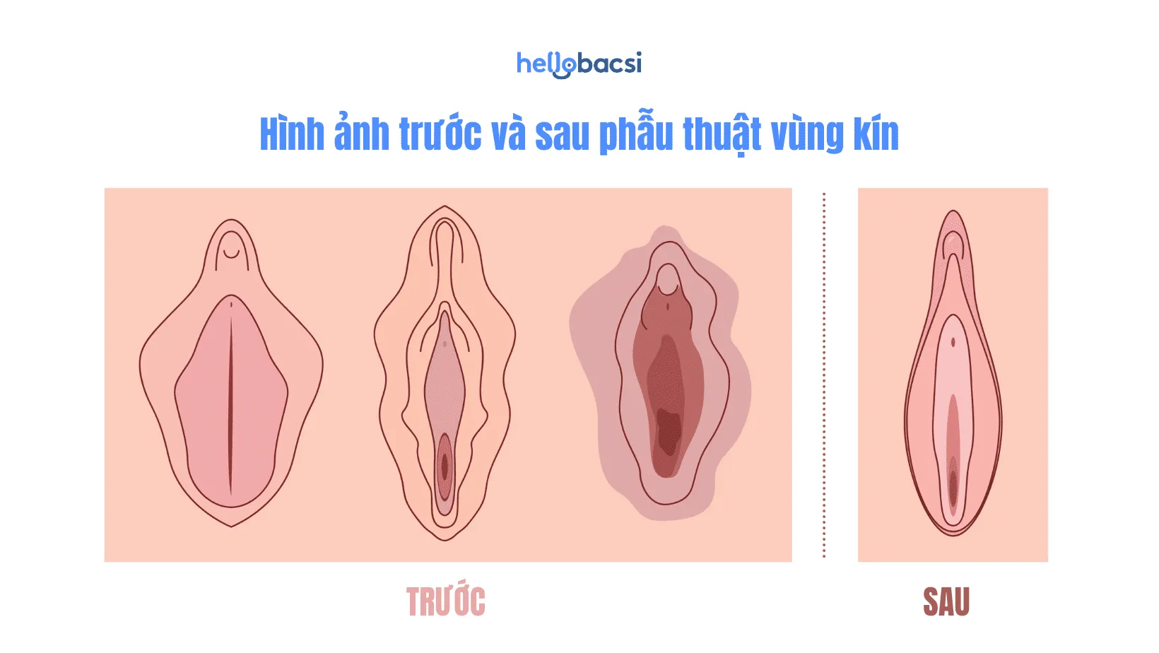 Môi bé là gì? Cấu tạo, vị trí, chức năng và các vấn đề thường gặp