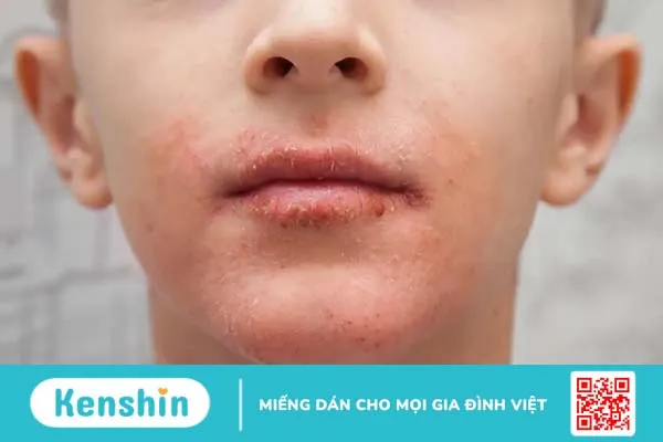 Môi bị chàm: Tình trạng phổ biến nhưng dễ nhầm lẫn!