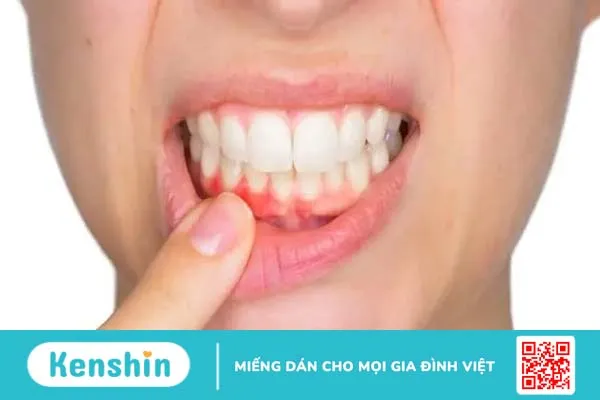 Mối liên hệ giữa các bệnh lý tim mạch và bệnh nha chu