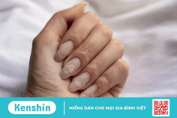 Móng tay bị gãy: Chuyện nhỏ hay dấu hiệu bệnh tật?