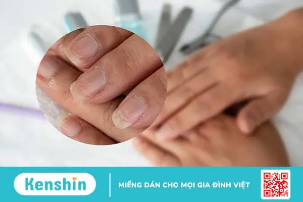 Móng tay bị rỗ là bệnh gì? Điều trị như thế nào hiệu quả?