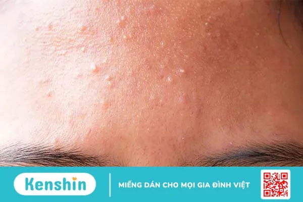 Mụn ẩn là gì? Cách trị mụn ẩn dưới da triệt để, an toàn