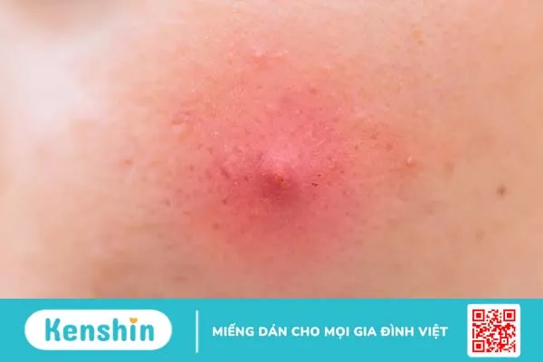 Mụn bọc ở cằm có nên nặn không? Nguyên nhân & cách điều trị