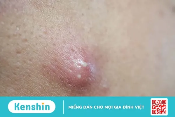 Mụn bọc ở má: Không cẩn thận sẽ lây lan nhanh, kém xinh đẹp