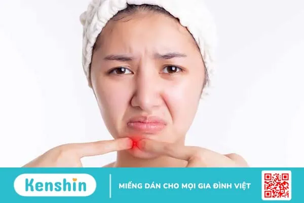 Mụn bọc ở má: Không cẩn thận sẽ lây lan nhanh, kém xinh đẹp