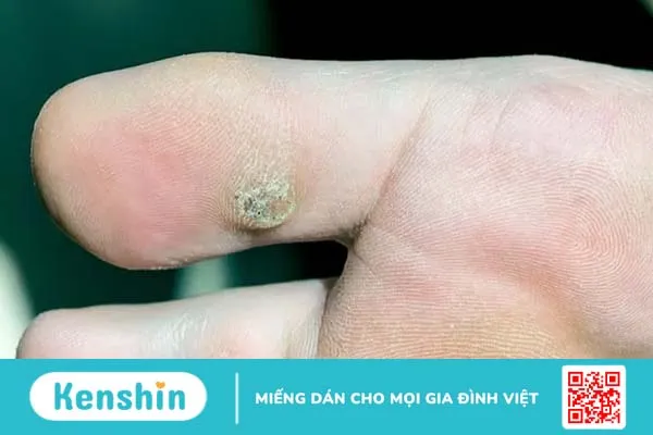 Mụn cóc là gì? Nguyên nhân và cách phòng chống mụn cóc