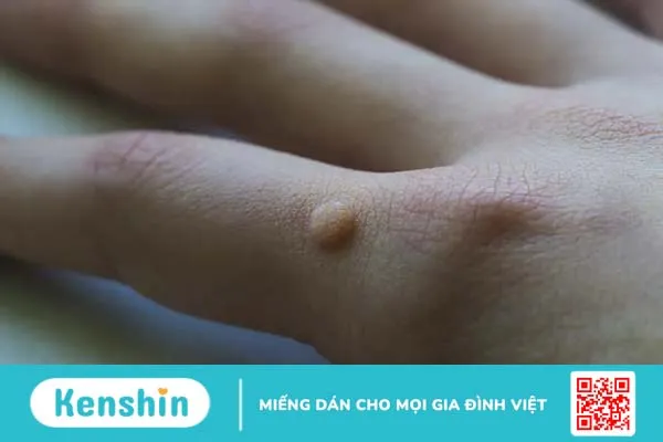 Mụn cơm là gì? Nguyên nhân, cách phân biệt và điều trị