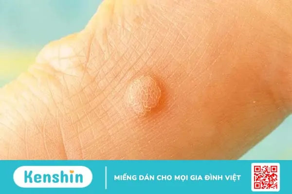 Mụn cơm là gì? Nguyên nhân, cách phân biệt và điều trị