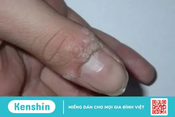 Mụn cơm là gì? Nguyên nhân, cách phân biệt và điều trị