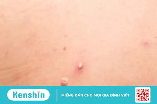 Mụn đầu trắng: Nguyên nhân, cách điều trị và phòng ngừa