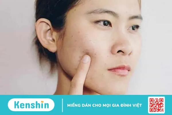 Mụn do rối loạn nội tiết tố: Nguyên nhân & Cách điều trị tận gốc