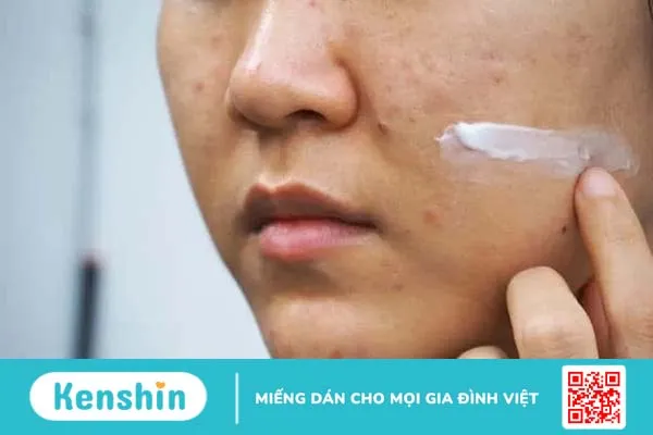 Mụn do rối loạn nội tiết tố: Nguyên nhân & Cách điều trị tận gốc