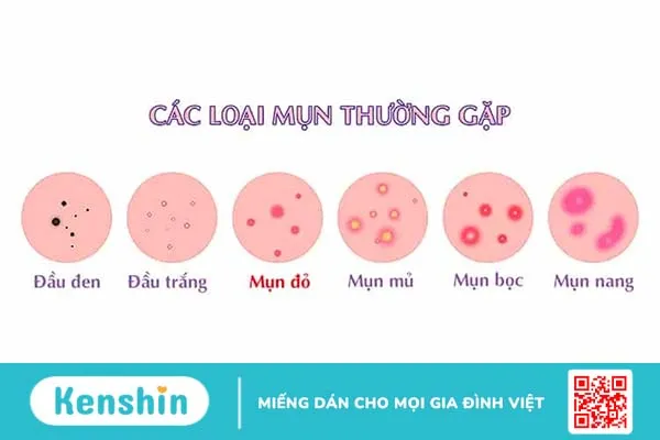 Mụn đỏ sưng tấy: Nguyên nhân và Cách điều trị dứt điểm