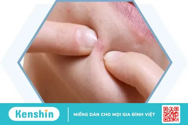 Mụn dưới cằm: Nguyên nhân và cách điều trị