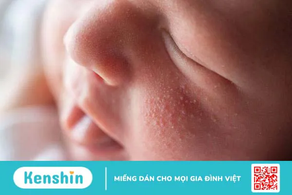 Mụn hạt kê là gì? Cách chữa mụn hạt kê ở trẻ sơ sinh ra sao?