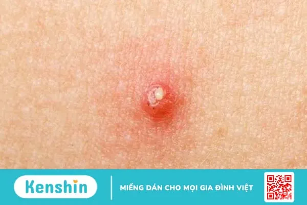 Mụn nhọt: Những điều cần biết về mụn nhọt để tránh nhiễm trùng