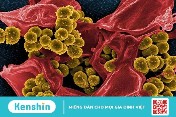 Mụn nhọt: Những điều cần biết về mụn nhọt để tránh nhiễm trùng