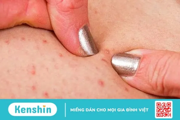 Mụn nhọt ở mông và những điều cần biết