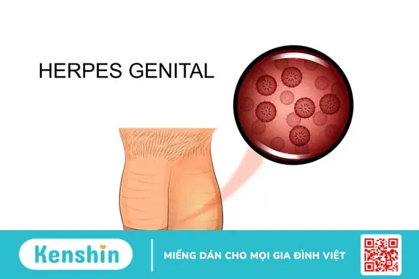 Mụn rộp sinh dục giai đoạn đầu có nguy hiểm không?