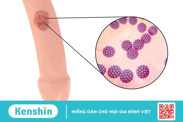 Mụn rộp sinh dục giai đoạn đầu có nguy hiểm không?