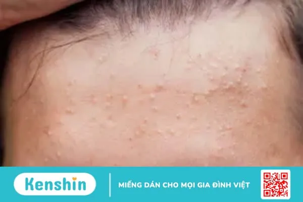 Mụn sẩn là gì? Nguyên nhân và cách điều trị mụn sẩn