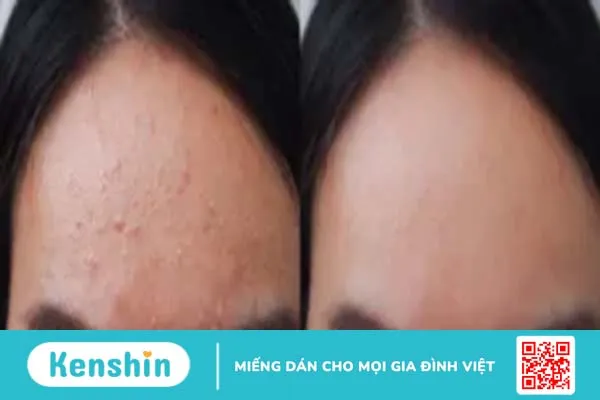 Mụn sẩn là gì? Nguyên nhân và cách điều trị mụn sẩn