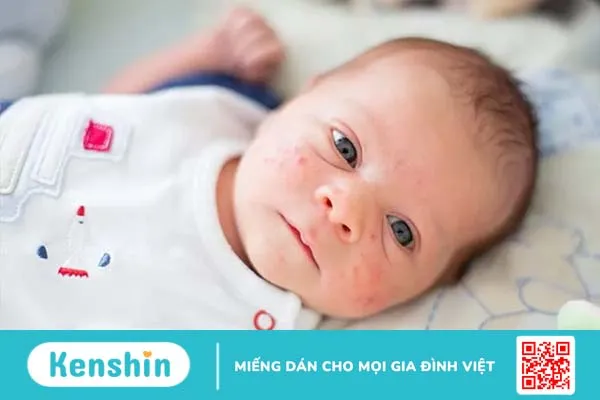 Mụn sữa ở trẻ sơ sinh có tự hết không? Cách trị mụn sữa hiệu quả