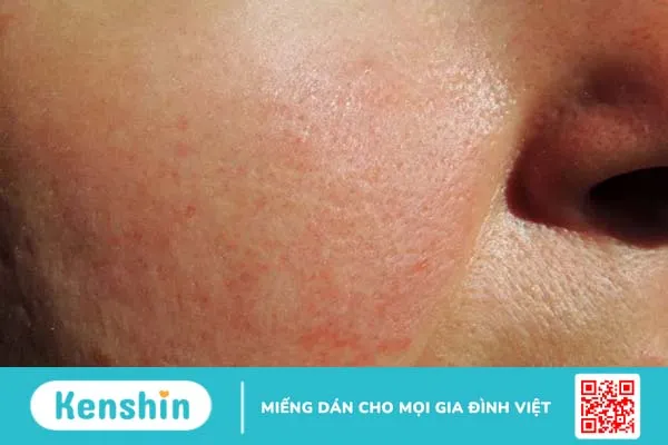 Mụn trứng cá đỏ và những điều bạn cần biết