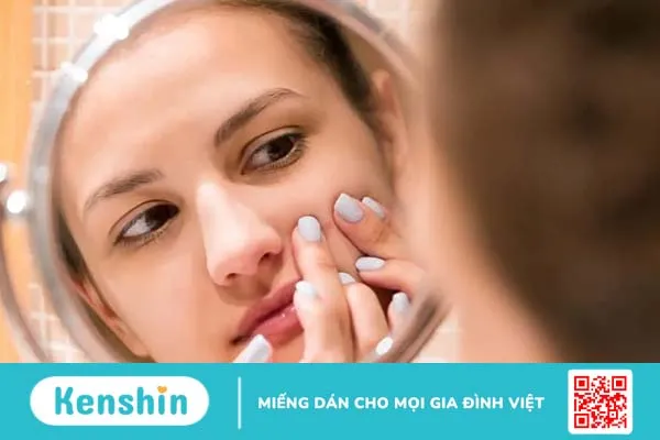 Mụn trứng cá ở tuổi dậy thì: Nguyên nhân và cách điều trị