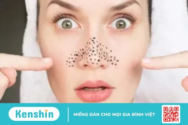 Mụn trứng cá: nguyên nhân, triệu chứng và cách điều trị