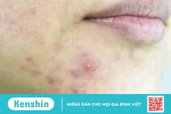 Mụn trứng cá: nguyên nhân, triệu chứng và cách điều trị