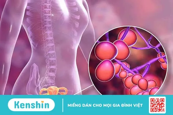 Nấm âm đạo là bệnh gì mà đến 75% phụ nữ có nguy cơ mắc phải?