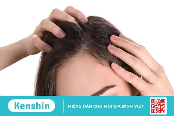 Nấm da đầu: Triệu chứng và cách phòng ngừa