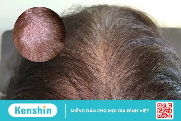 Nấm da không ngứa là dấu hiệu bệnh da liễu nào?