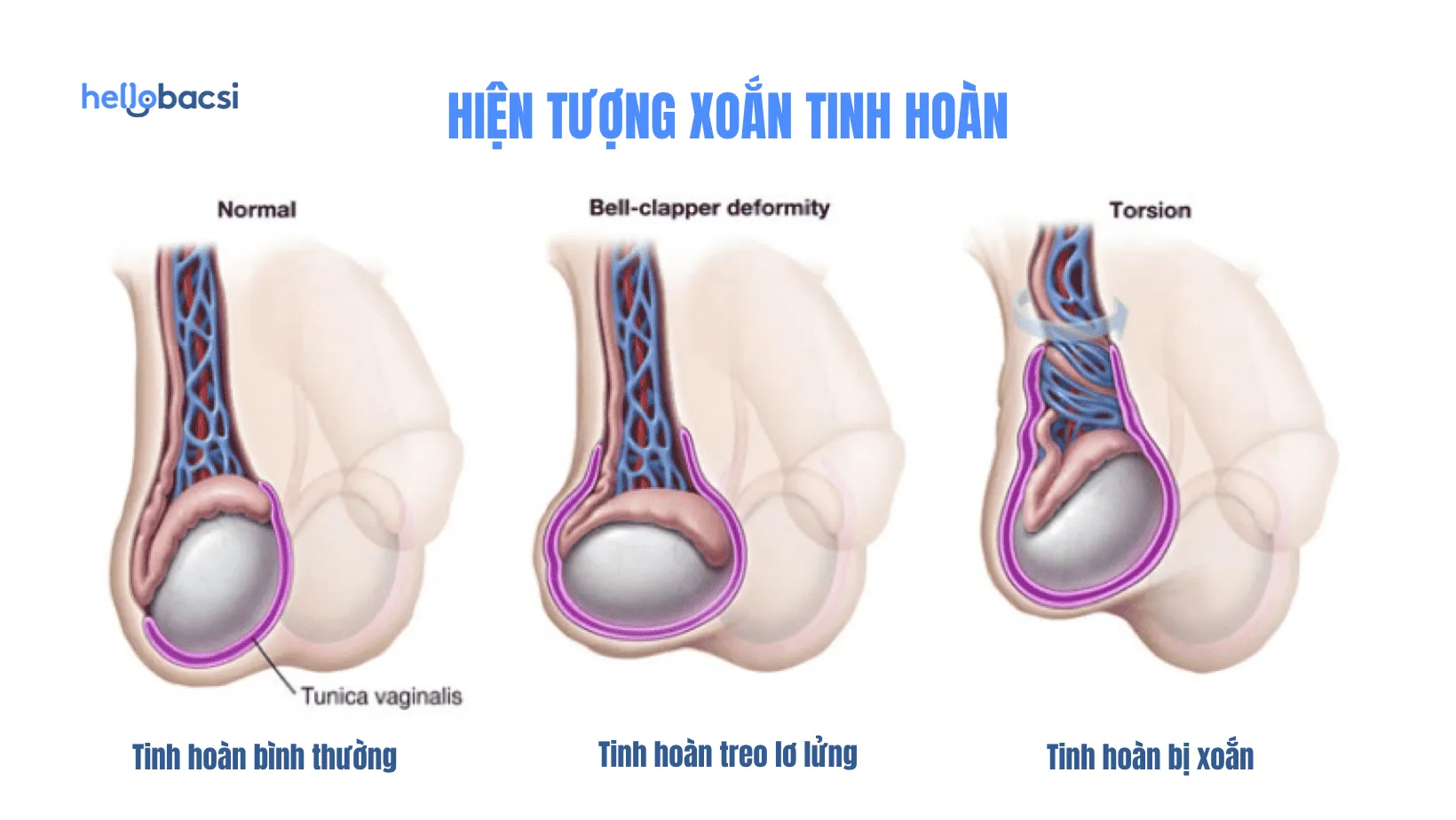 Nam giới bị teo tinh hoàn có chữa được không?