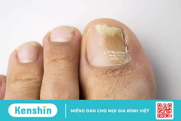 Nấm móng chân: Ai dễ mắc? Nguyên nhân và cách điều trị là gì?